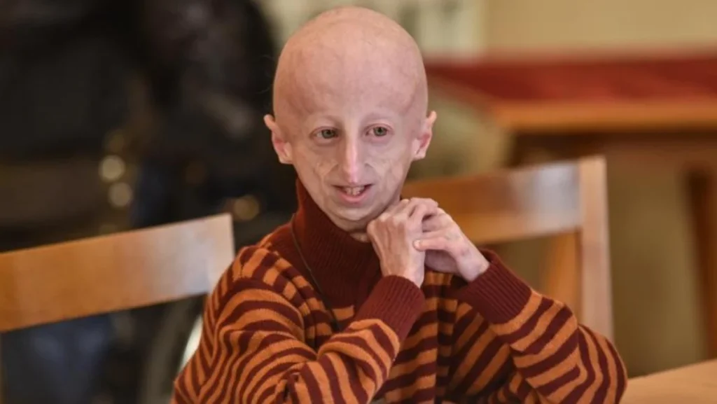 Sammy Basso Penderita Progeria Meninggal Dunia di Usia 28 Tahun